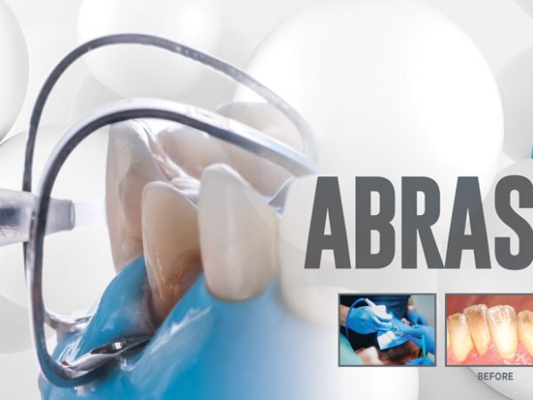 Is Air Abrasion for&nbsp;You?