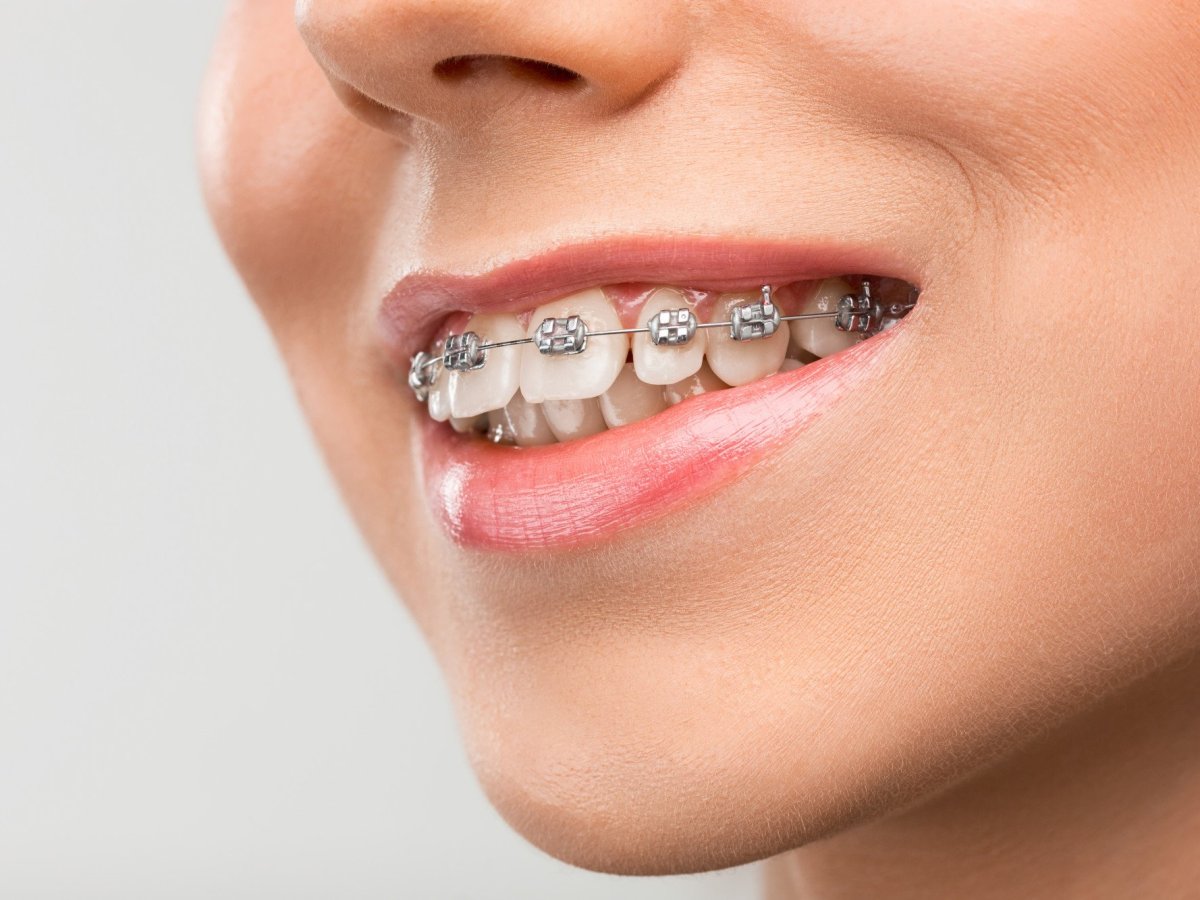 Braces – FAQ